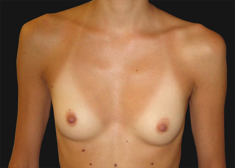 breast_enlargement_before
